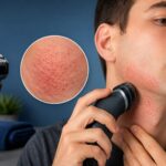 Electric Shaver Razor Burn: Causes and How to Prevent It